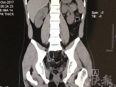 小伙體內藏毒300余克 CT掃描圖密密麻麻全是蠶蛹