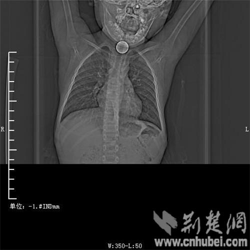 6歲男童玩耍被1元硬幣卡住喉 窒息險(xiǎn)喪命(圖)